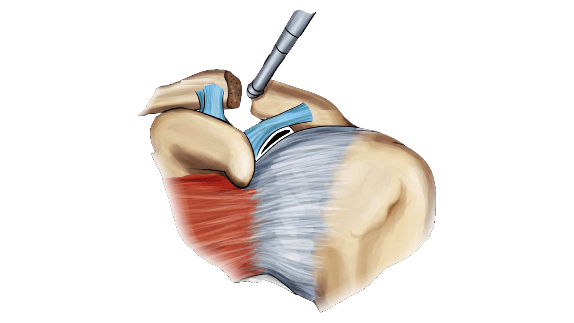 AC Joint Arthritis Surgery