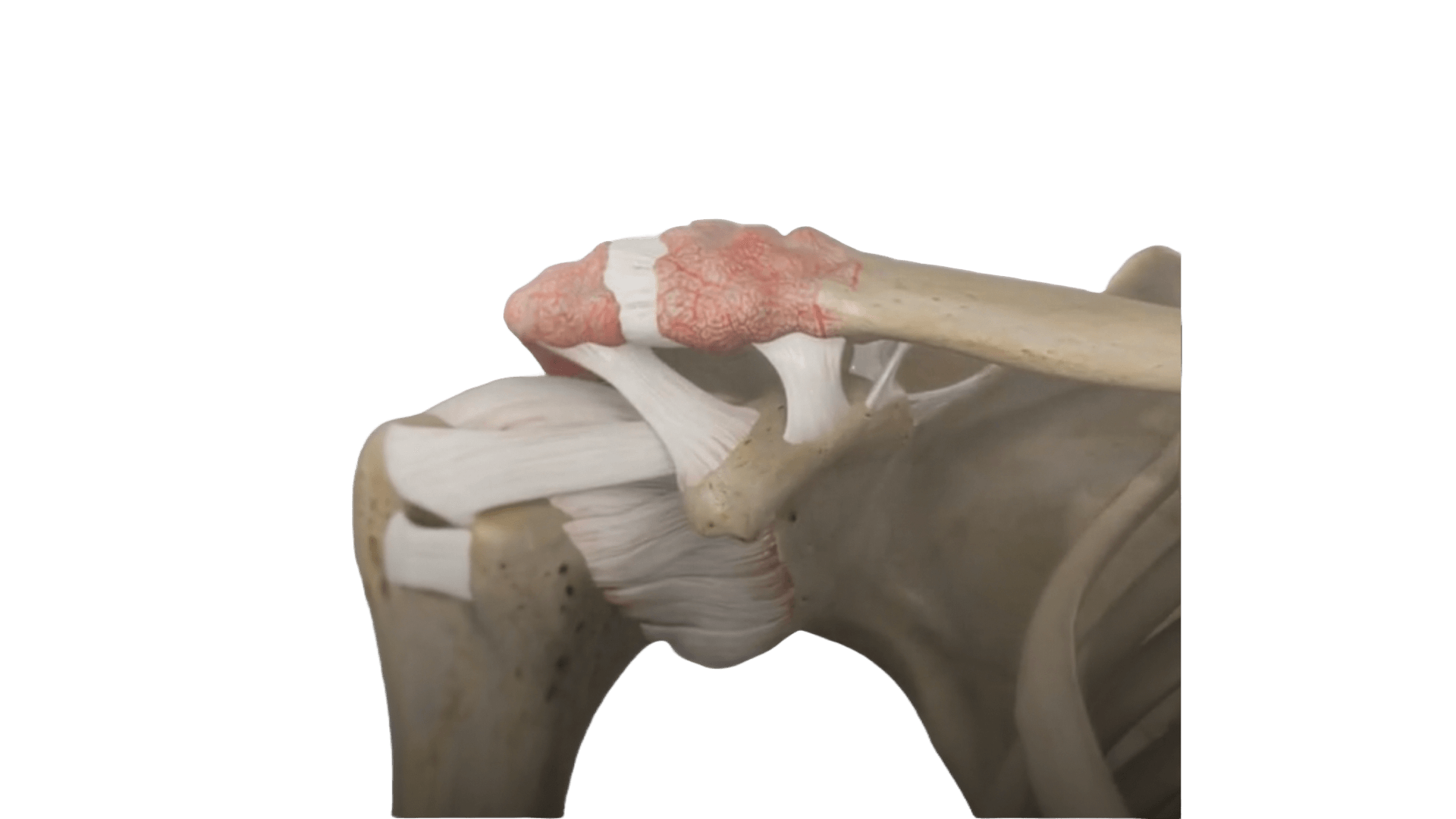 AC Joint Arthritis