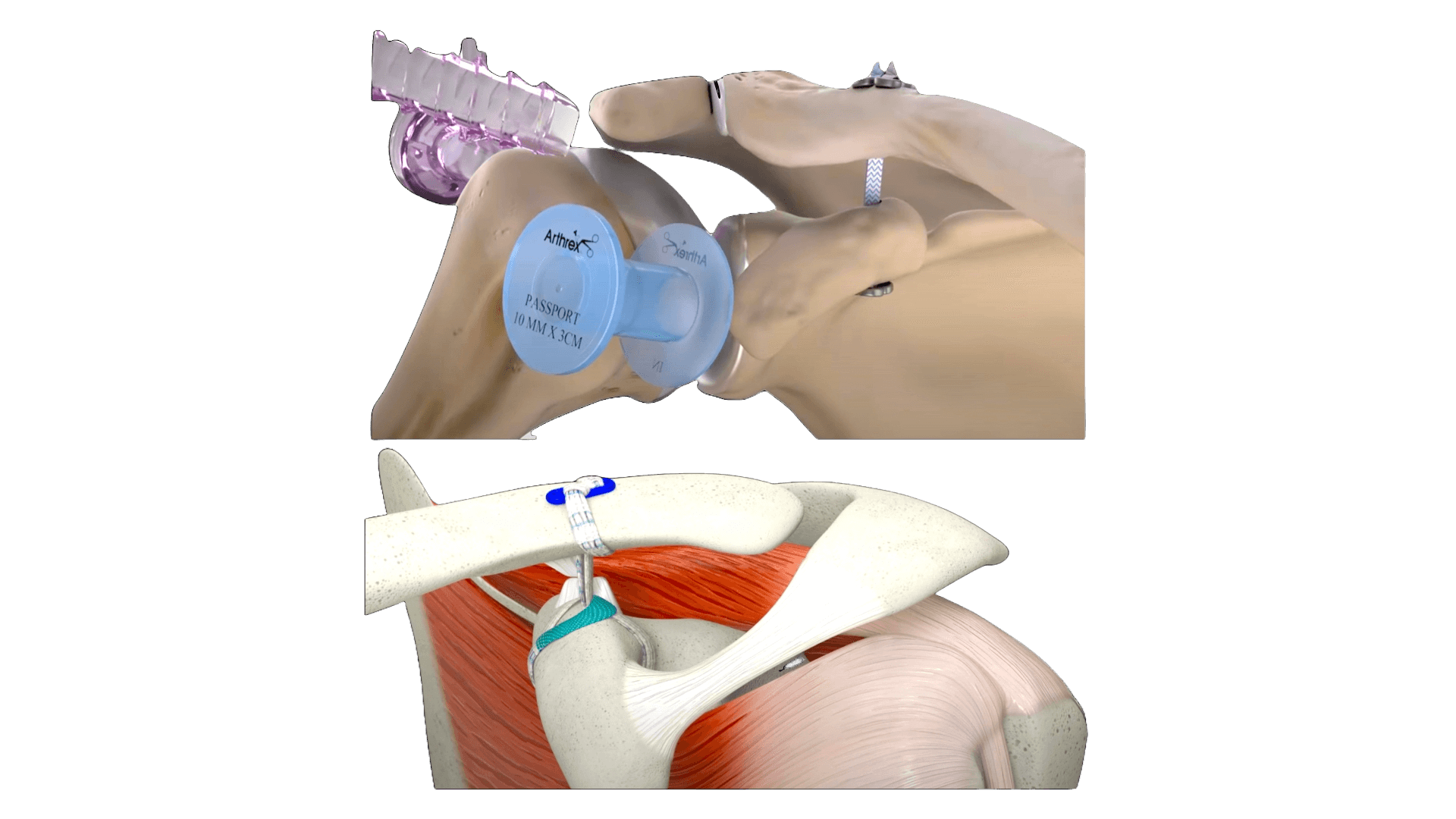 Biceps Tendon Repair Surgery