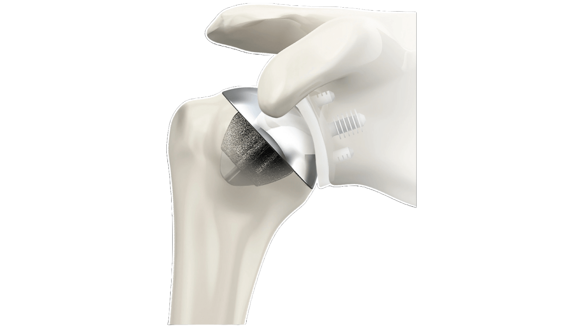 Anatomic Total Shoulder Replacement