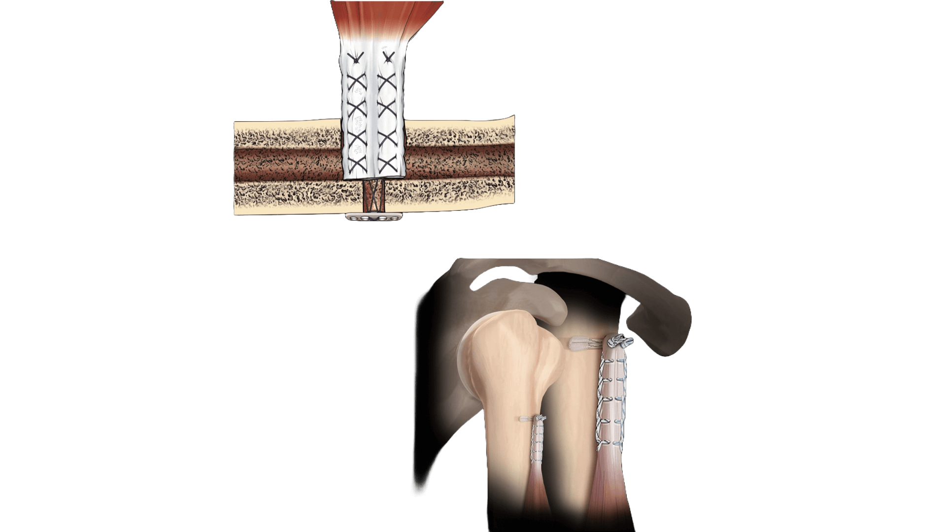 Biceps Tendon Repair Surgery