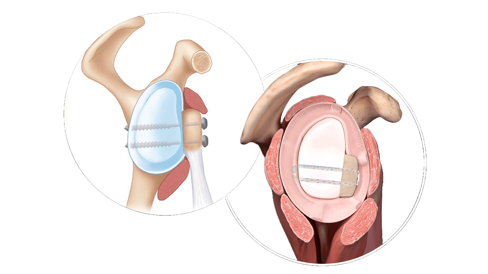 Bone Graft Technique