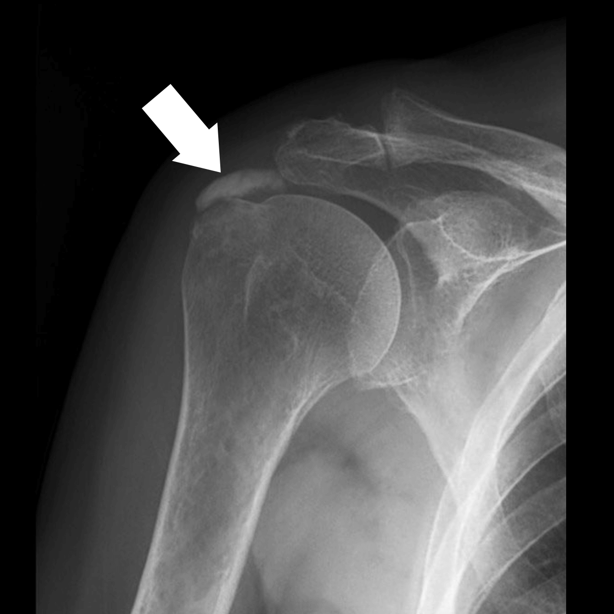 Calcific Tendinitis