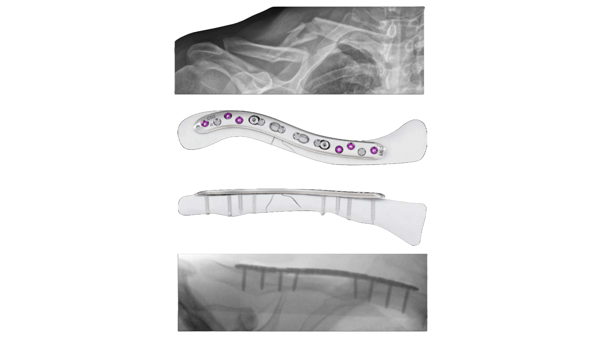 Collarbone Fracture Fixation Surgery