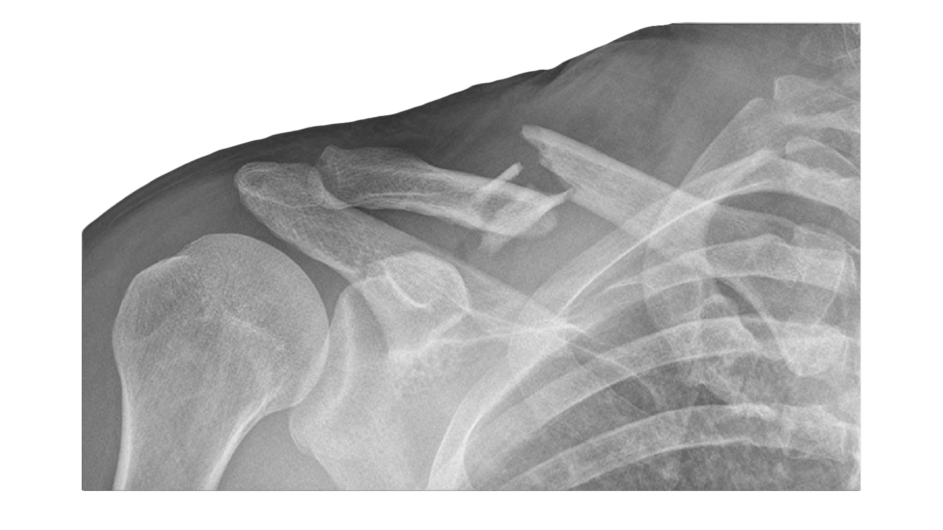 Collarbone Fractures