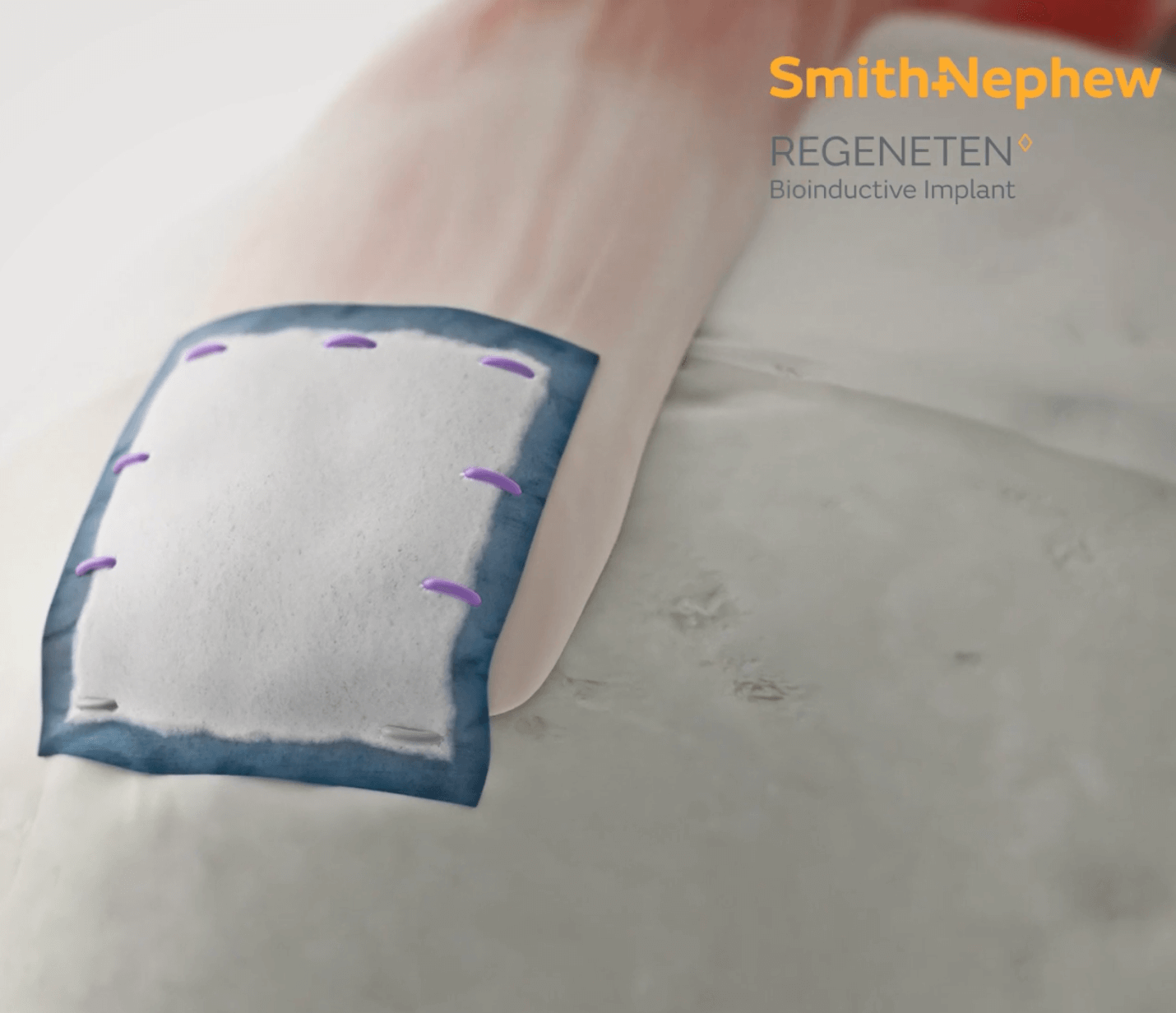 Complex Rotator Cuff Repair with Graft Augmentation Surgery