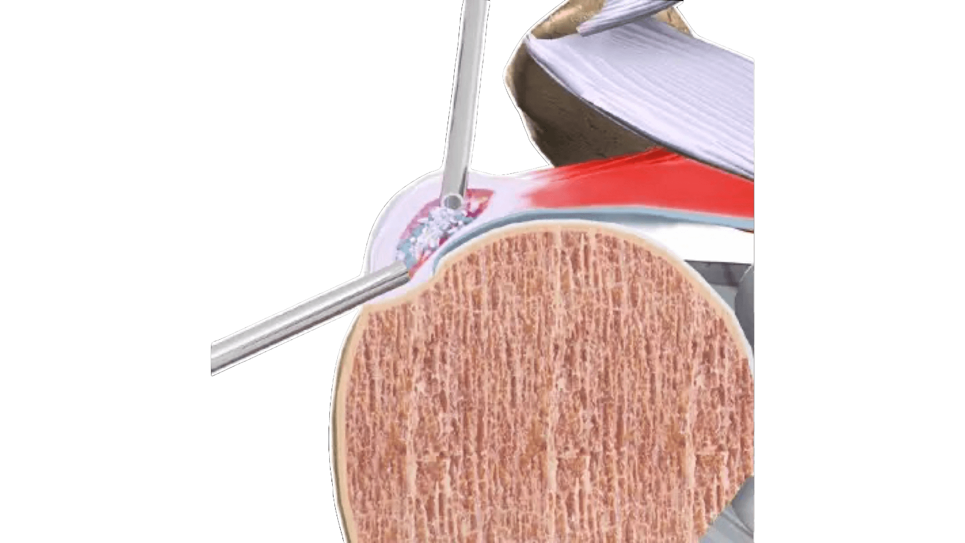 Excision of Calcific Tendinitis Surgery