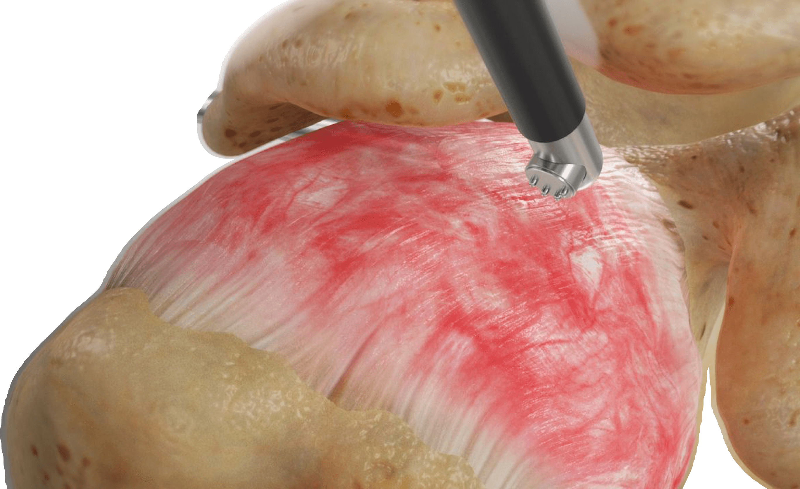 Frozen Shoulder Release Surgery