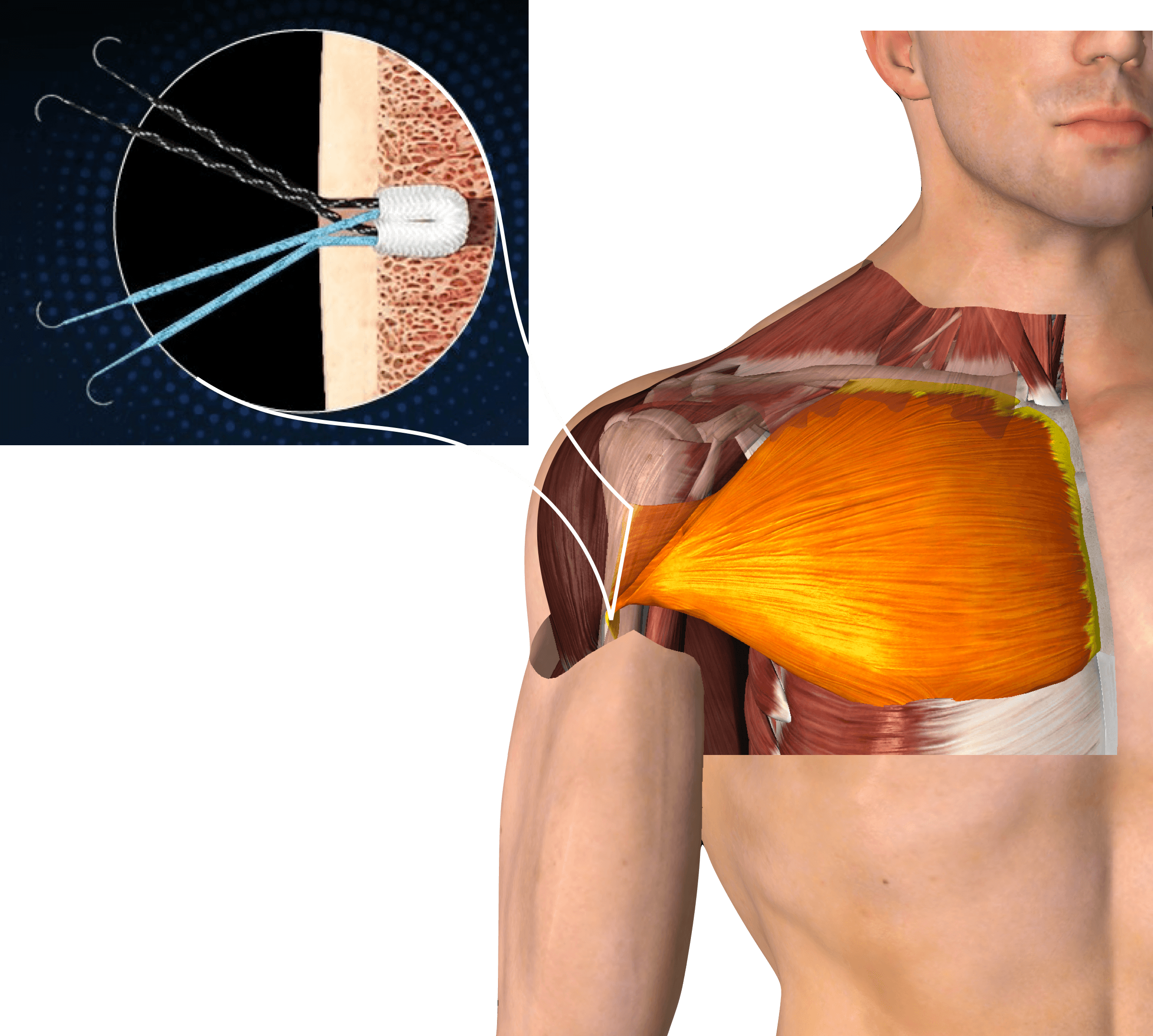 Pec Major Repair Surgery