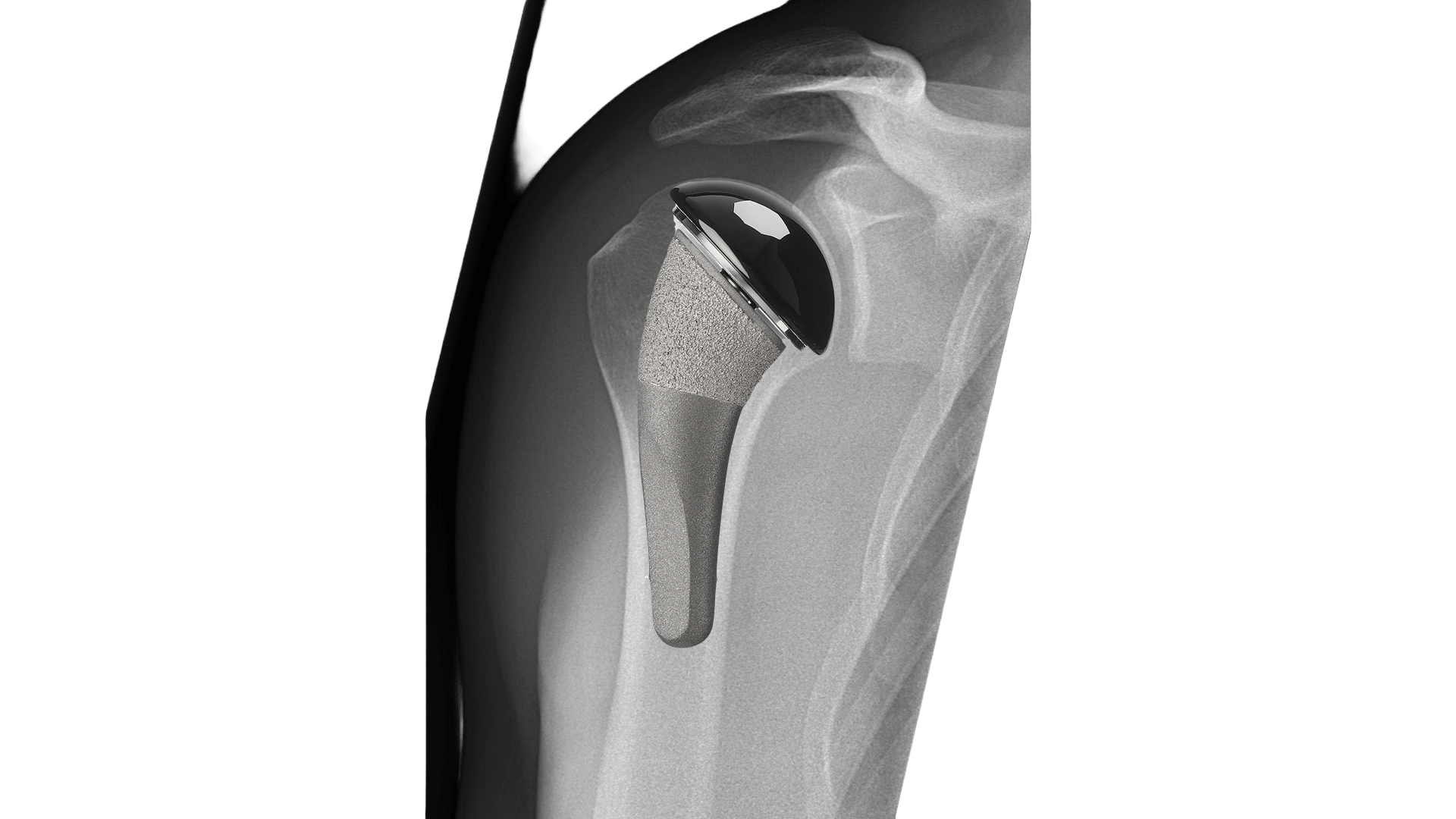 Pyrocarbon Hemiarthroplasty
