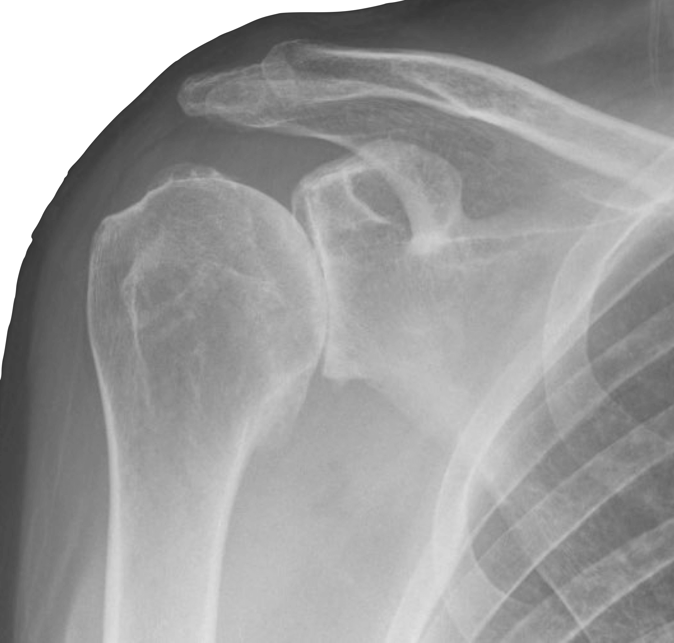 Shoulder Arthritis