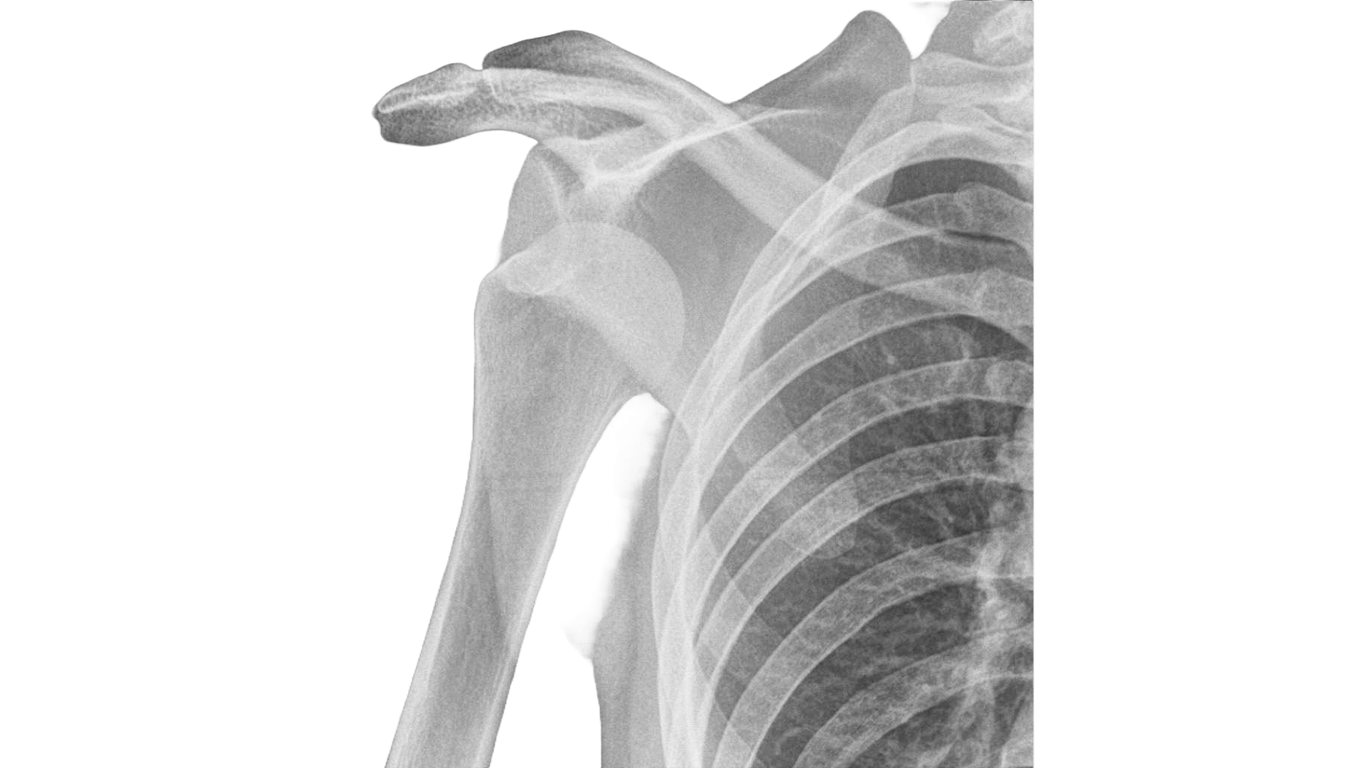 Shoulder Dislocation