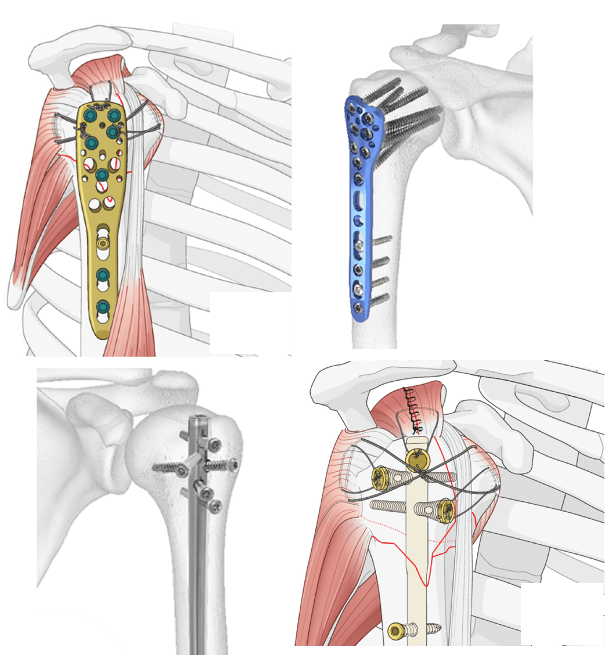 Shoulder Fracture Fixation Surgery