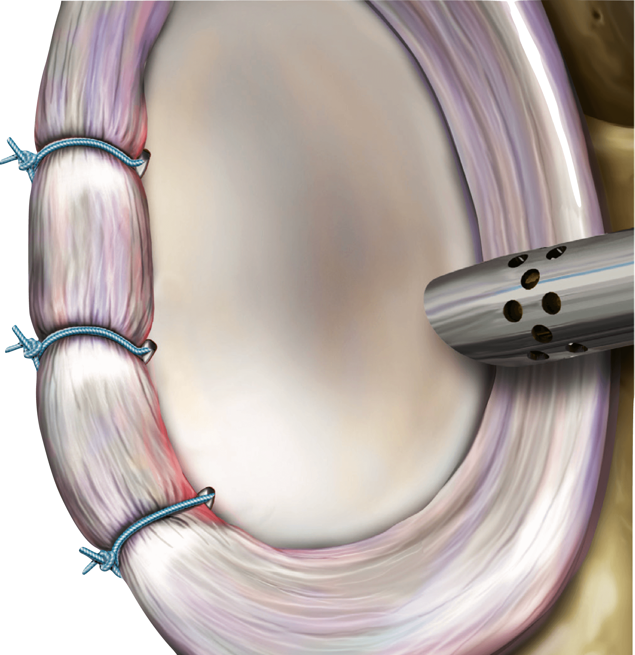 Shoulder Stabilisation Surgery